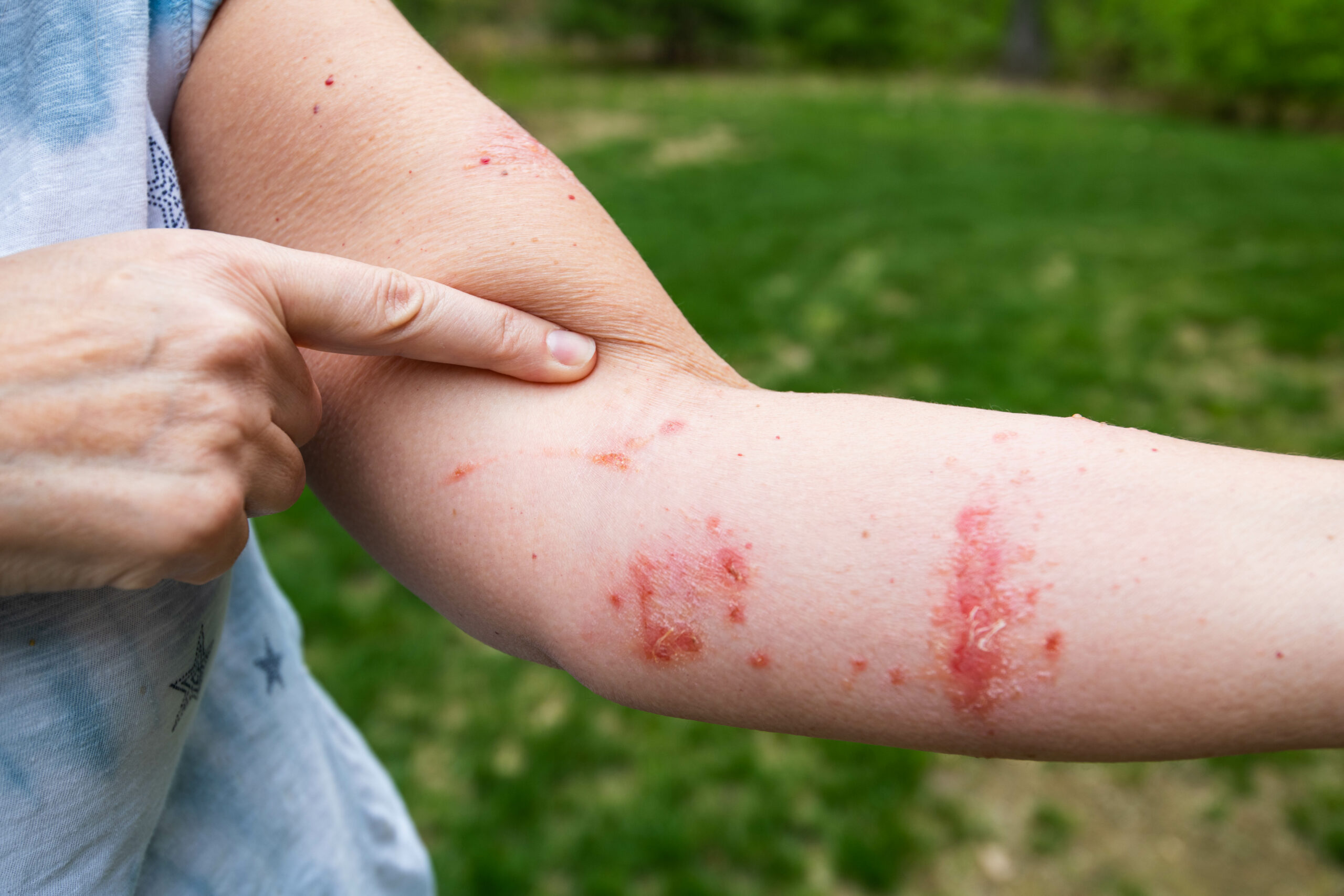 Rash (Skin Conditions)