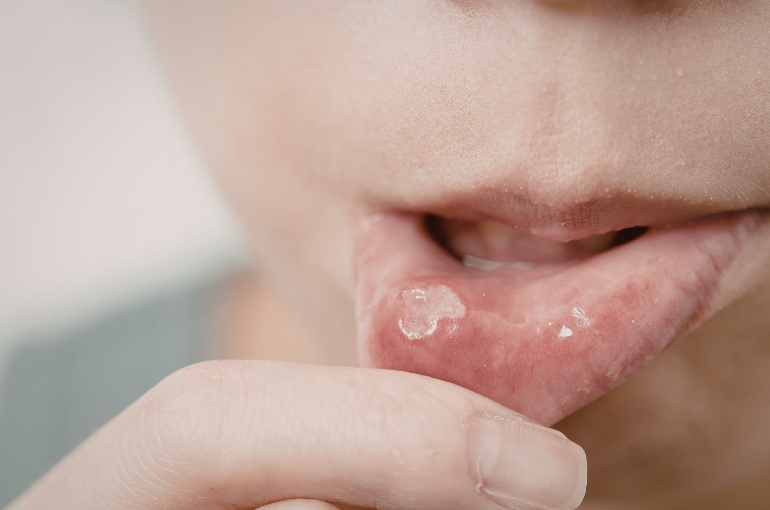 Guide to Getting Online Cold Sore Treatment Without a Doctor Visit